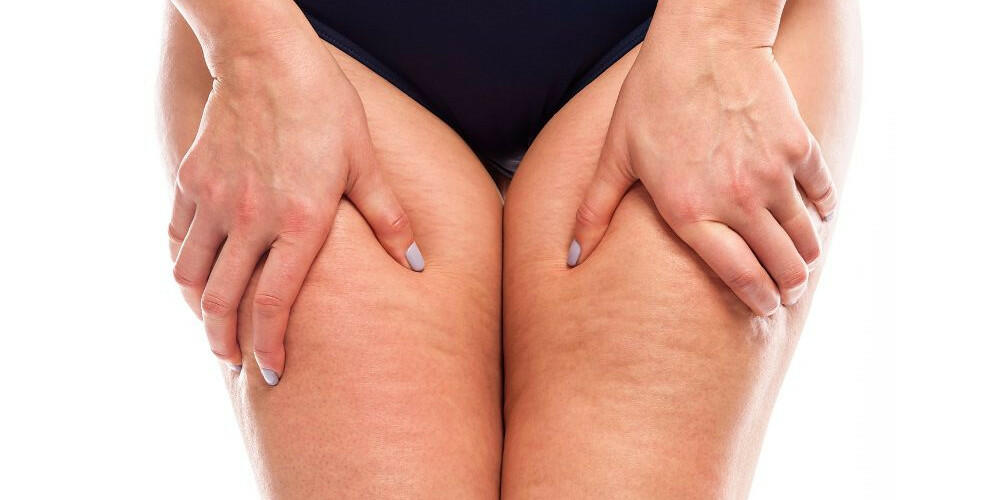 I nostri consigli su come combattere la cellulite